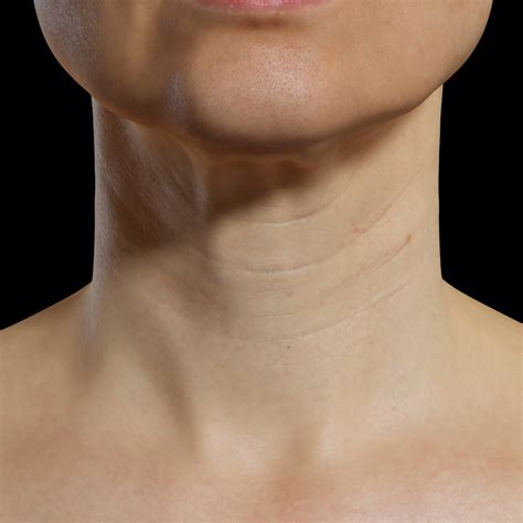 mesotherapy-neck-laxity-non-surgical-neck-lift-clinique-chloé