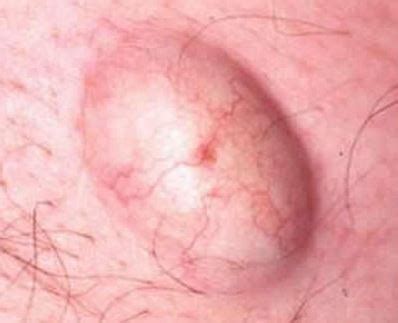 If you are using mobile phone, you could also use menu drawer from browser. Inflamed Hair Follicle Penis - Homemade Movie Porn