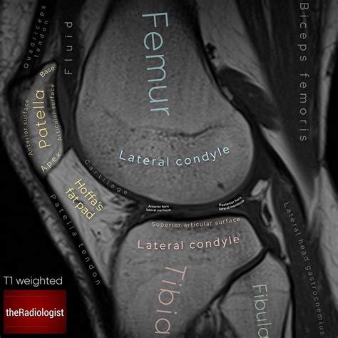 Tibial tuberosity with distal patella tendon insertion. The Radiologist on Instagram: "Take a look at these images showing the anatomy of a knee MRI and ...