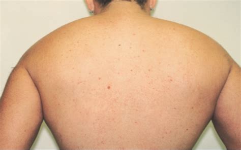 L'épilation laser est une technique visant à détruire les poils de façon définitive. Epilation laser médicale définitive - Dr Dellac ...