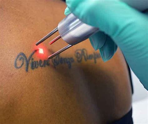 A french research team found that blocking the immune system's own macrophages—cells that identify and engulf cellular debris, microbes and other foreign bodies—would likely help erase tattoos'. Tattoo Removal Devices Market Research Report | Latest ...