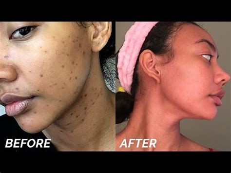How to remove blemishes from your face. How to get rid of hyperpigmentation on face ...