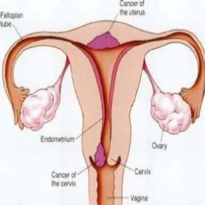 Some people experience other symptoms as well. 5 Ways To Treat Pelvic Cancer | Lady Care Health