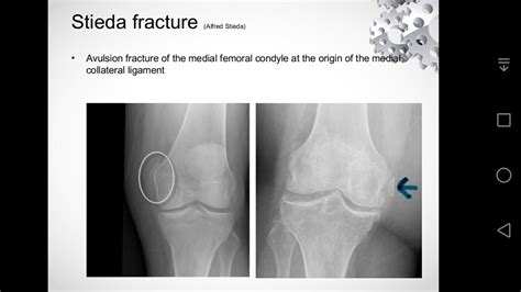 Spot diagnosis? Identify the fracture