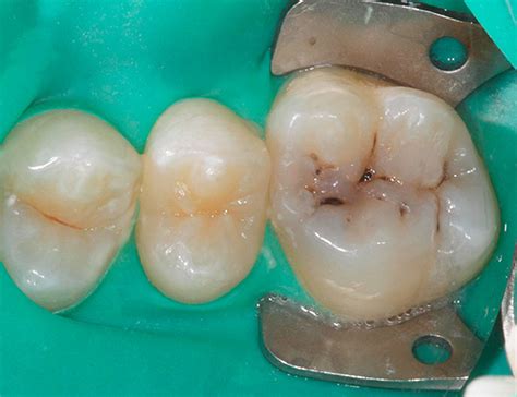 Ces aliments contiennent des substances susceptibles de les afin de diminuer son effet négatif sur les dents, l'idéal est de réaliser un bain de bouche, et de bien se rincer la bouche après en avoir consommé. À quoi ressemblent les caries sur les dents: photos et ...