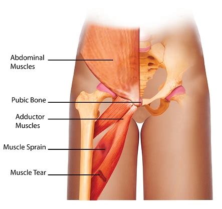 Often groin strain occurs in the area of inguinal ligament. Groin Strain - Causes, Symptoms and Treatments | SportNova UK