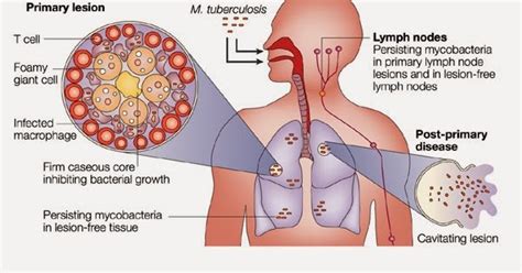 Bakteri ini juga disebut abasilus koch. Mengenal Penyakit Tb ( Tuberculosis ), Penularannya Dan ...