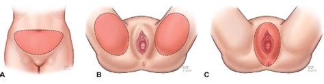 Diagram of groin muscles see more about diagram of groin muscles diagram of female groin muscles diagram of groin injury diagram of groin muscle in human male. Defined anatomic locations of the suprapubic area (A), groin (B), and... | Download Scientific ...