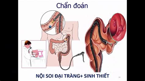 video 10 ung thư trực tràng p1: Ung thư đại tràng trực tràng | Tổng quan kiến thức Phần 2 ...