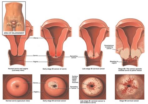 When cancer starts in the cervix, it is called cervical cancer. Cervical Cancer - Physiopedia