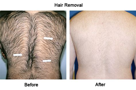 Press the strip on the wax, rub the strip to let it settle and then pull the strip away. laser hair removal campbelltown, Mount Annan, Camden Park ...