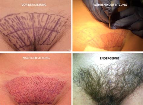 Da ich auch ein großes problem mit haarausfall hatte, habe ich mich zum diesem schritt entschieden und. Haartransplantation Forum : Ärzte und Kliniken - VOR dem ...