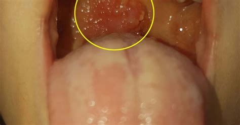 This is known as the adam's apple. The Health Website : Causes of Laryngeal (Throat) Cancer