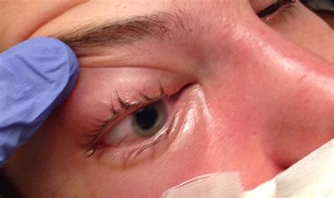 Mucormycosis (previously called zygomycosis) is a serious but rare fungal infection caused by a group of molds called mucormycetes. Lethargy and vision loss: successful management of ...