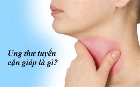 Loại ung thư tuyến giáp này khá giống với thể nhú, có thể di căn hạch ở cổ nhưng tốc độ di căn nhanh hơn, xa hơn, thậm chí có thể di căn tới xương. Ung thư tuyến cận giáp là gì? - Phòng khám sản 43 Nguyễn Khang