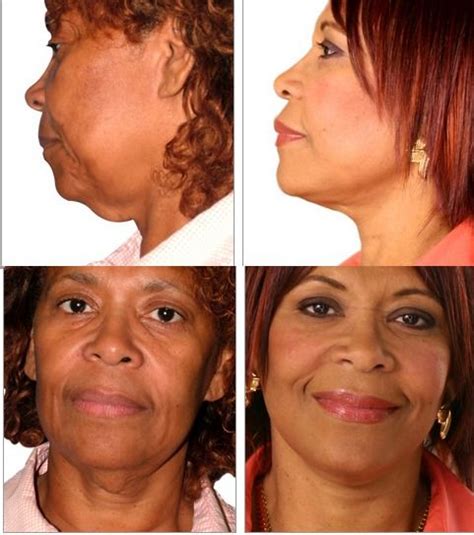 Jowls, sagging skin- Ena, age 60, had the Lifestyle Lift ...