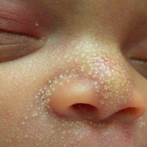However, it may not be milia or cholesterol, since there are many other possible causes of white spots or dots on eyelid, including skin cancer. Milia in newborns: causes, symptoms, treatments | Medical diagnosis