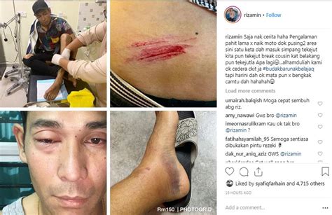 Punca penuaan, pernah cedera teruk masa muda , ahli sukan paling byk cedera macam ni ( lawak sy mengambil stem cell utk menghidupkan kembali sel pada bahagian tulang buku lali.lebih 20. Sepihan motor masuk mata, buku lali bengkak - Riz Amin ...