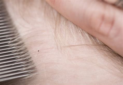 6 many aromatic oils can help remove lice and nits from hair, which are killed by these fragrances: Remedies to Remove Lice Eggs From Hair | LIVESTRONG.COM