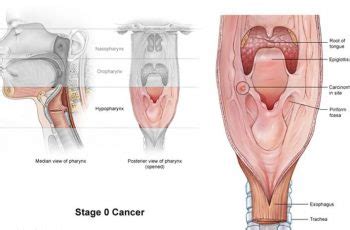 28 percent had a stubborn sore throat, and only 10 percent had trouble swallowing, the findings showed. What Throat Cancer Feels Like - Cancer News Update