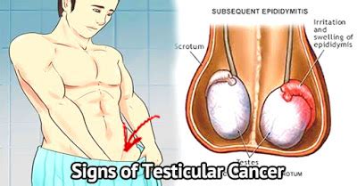 Testicular cancer, also called testis cancer, is typically treated with surgery, chemotherapy and sometimes radiation therapy. WARNING: Check your Private Part for any Signs of ...