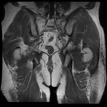 Pelvic ring fracture | Image | Radiopaedia.org