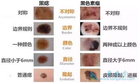 发 给 你 兄 弟. 发育不良痣与黑色素瘤是什么关系？-康安途海外医疗