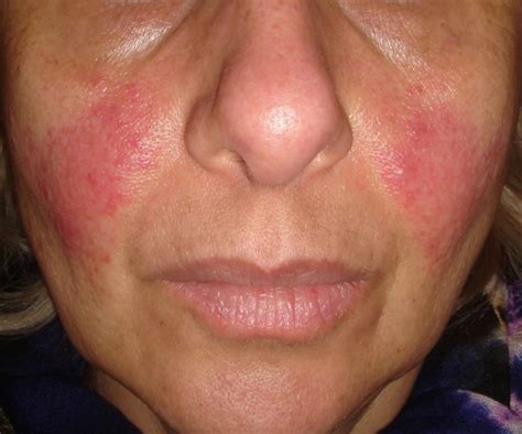 I have only had rosacea for a few years, came on a little while after i had a baby. Generic Rosacea Treatment Wins Tentative FDA Approval ...
