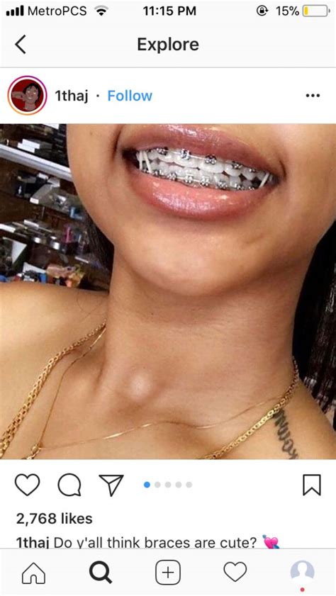 Dental braces are appliances which are used to align or straighten the teeth and guide the teeth to the corrected position. #braces #braces #appreciation | Dental braces, Braces ...
