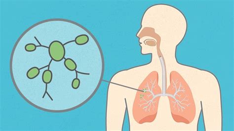 What happens after my breast cancer surgery? Questions About Lymph Nodes | Everyday Health