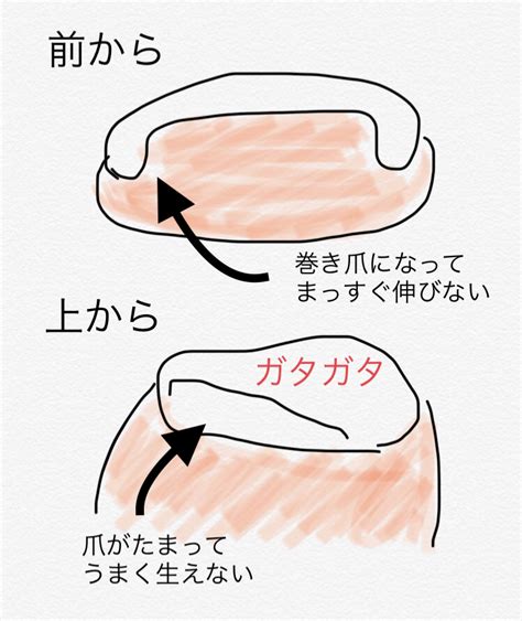 Botsuraku youtei nanode, kajishokunin wo mezasu manga: 【実録】小さくて醜すぎる足の小指の爪を、本気できれいに ...