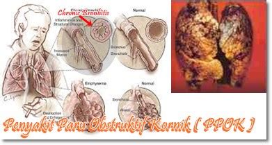Obstruksi saluran napas pada ppok bersifat ireversibel dan terjadi karena perubahan struktural pada saluran napas kecil yaitu : Mantri Muda: ASUHAN KEPERAWATAN PADA Tn.S DENGAN GANGGUAN ...