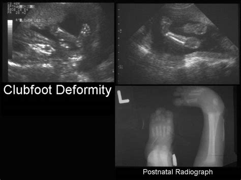 We have correlated the accuracy of the prenatal findings in 281 ultrasound surveys with the physical findings after birth. Abnormal 20 Week Ultrasound Pictures - Ldwtanka