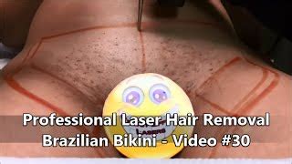 Bikini laser hair removal reduces ingrown hairs and razor bumps laser hair removal on the pubic area is effective and widely sought after. FULL BRAZILIAN LASER HAIR REMOVAL - VEA MAS VIDEOS DE ...