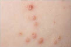 Molluscum contagiosum is a common viral skin infection that causes skin lumps, which can be itchy. Molluscum Contagiosum: A Common Viral Skin Condition In ...