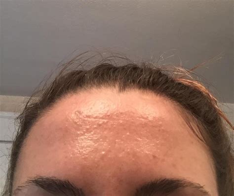 Before that, i had bad acne and loads of closed comedones, and it seemed to get rid of everything. routine help with dehydrated skin & closed comedones ...