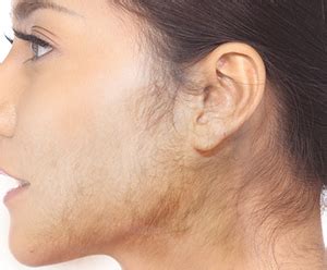 Each full press of the pump provides approximately 0.1 mg of. Hirsutism Treatment London, UK | Abnormal Hair Growth ...