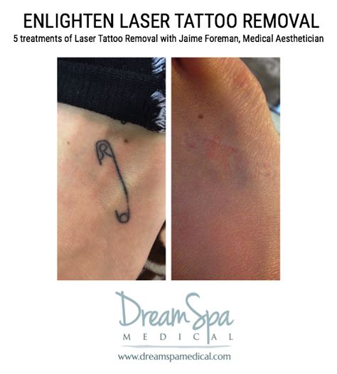 The dream tattoo removal md team looks forward to working with you to clear away your unwanted tattoos. Medical Tattooing For Stretch Marks