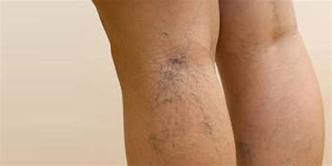 We did not find results for: pimzzone.blogspot.com: Endovenous Laser Cara Ampuh Atasi ...