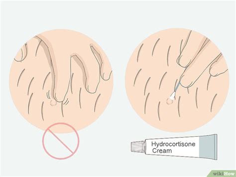 This causes darkening of the skin, localized pain, itching. Pin on Ingrown hair remedies bikini