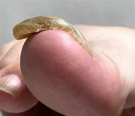 【閲覧注意】分厚く変形した足の爪を切るのに最適な爪切りを ...