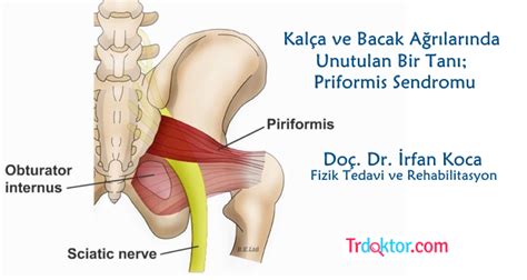 Görünen asıl problem, tetik noktaların varlığıdır. Kalça ve Bacak Ağrılarında Unutulan Bir Tanı; Priformis ...