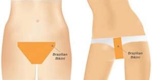 It includes the full pubic region, labia and perineal areas. Laser Hair Removal Seattle - Skinlogic Med Spa