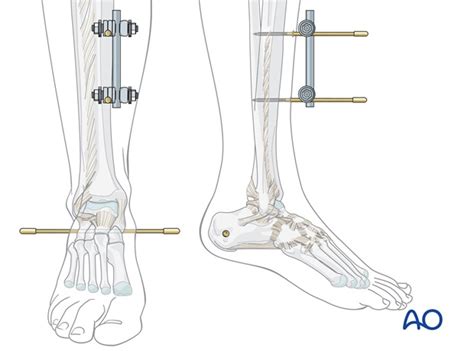 A technique of ankle arthrodesis. Triangular external fixation for Transsyndesmotic ...