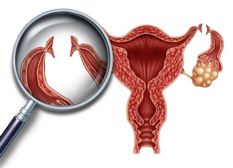 Jede frau hat einen individuellen zyklus, der immer am ersten tag der periode beginnt. Sterilisation der Frau um eine Schwangerschaft zu verhindern