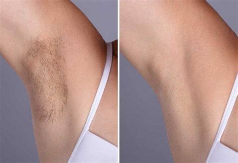 Things like inadequate hygiene, too much sweat passing through dead cells, friction from clothing, tight clothes, waxing and hair removal. Remove Underarm Hair - Easy Tricks and Home Remedies