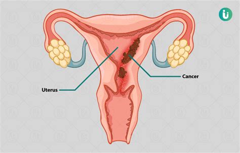 With a few all natural ingredients you can whip this up in. Uterine cancer kya hota hai Injec?ie de aur de alcoolism