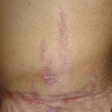 En el medio ambiente los hongos pertenecientes a este orden son ubicuos y se han aislado hasta en 22% de muestras de aire de hospitales. Mucormycosis diagnosis. A smear taken from skin lesion ...