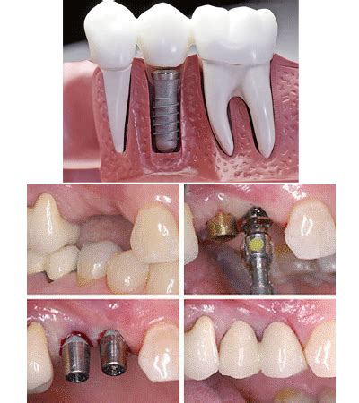 ∙ promo pengguna baru ∙ kurir instan ∙ bebas ongkir ∙ cicilan 0%. *Terbaik Implan Gigi Murah Medan - | Puri Dental Clinic