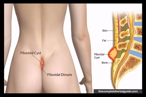 Unfortunately, there's no known way to prevent them from developing. How to get rid of a cyst on tailbone > ALQURUMRESORT.COM